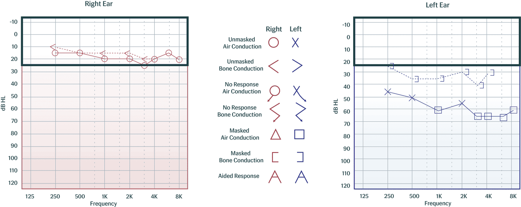 Audiogram Sensor The History of Audiometry and Audiometers - Auditdata