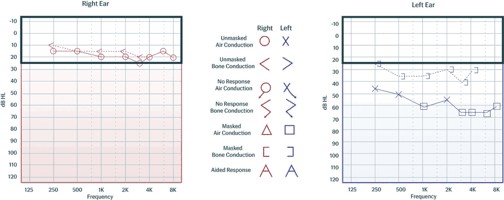Audiometry Components The History of Audiometry and Audiometers - Auditdata