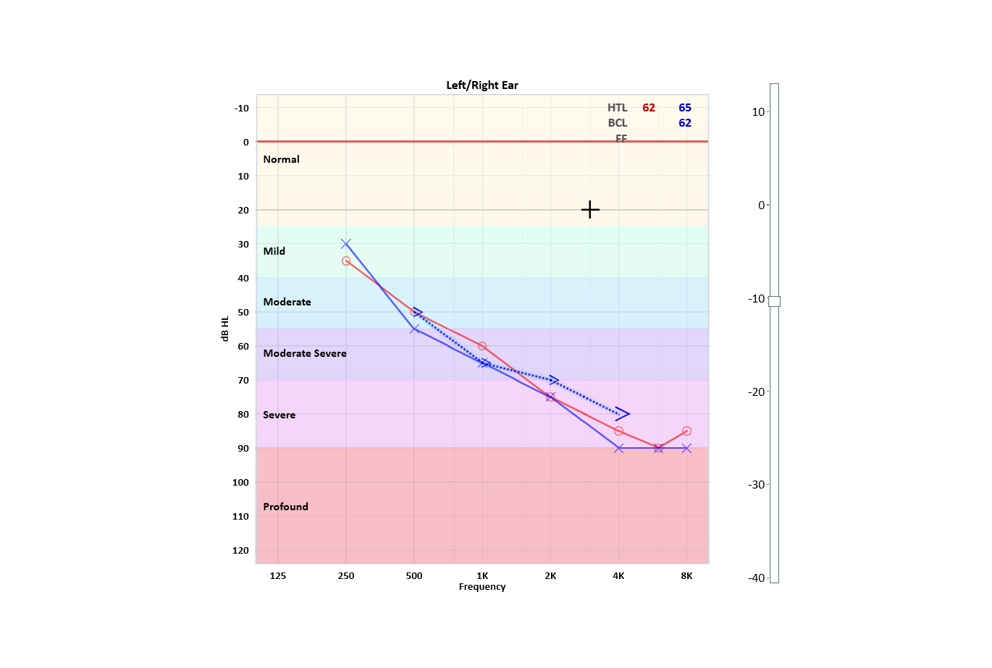 Sensorineural Hearing Loss Audiogram
