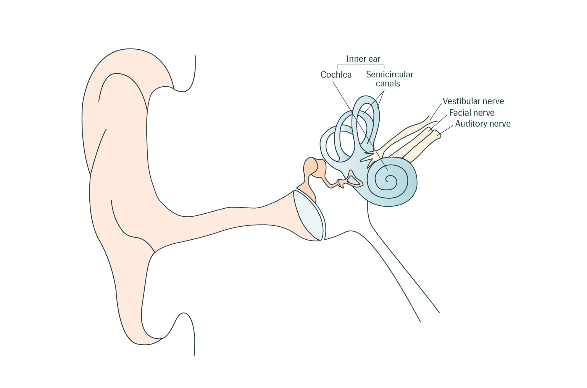 Coclear Damage Cochlear™ Case Studies | Middle Ear Disease and Cochlear Implant ...