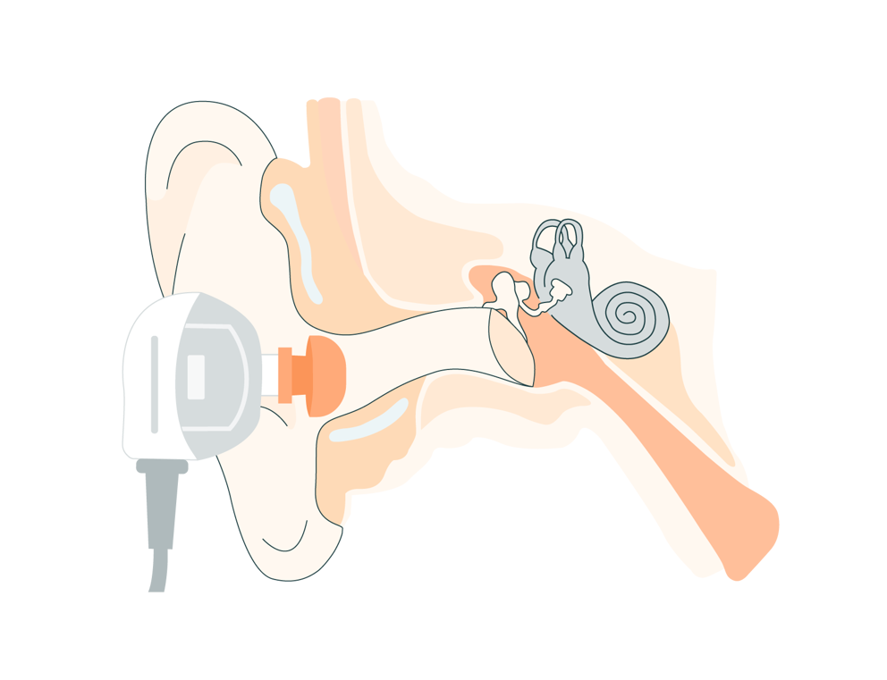 Middle Ear And Tympanometry