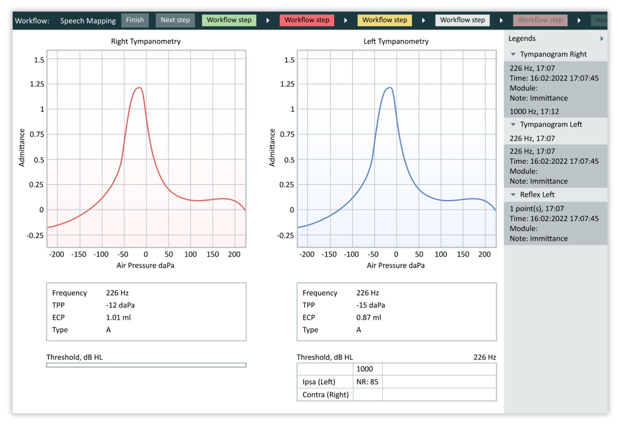Diagnosing Middle Ear Disorders with Tympanograms