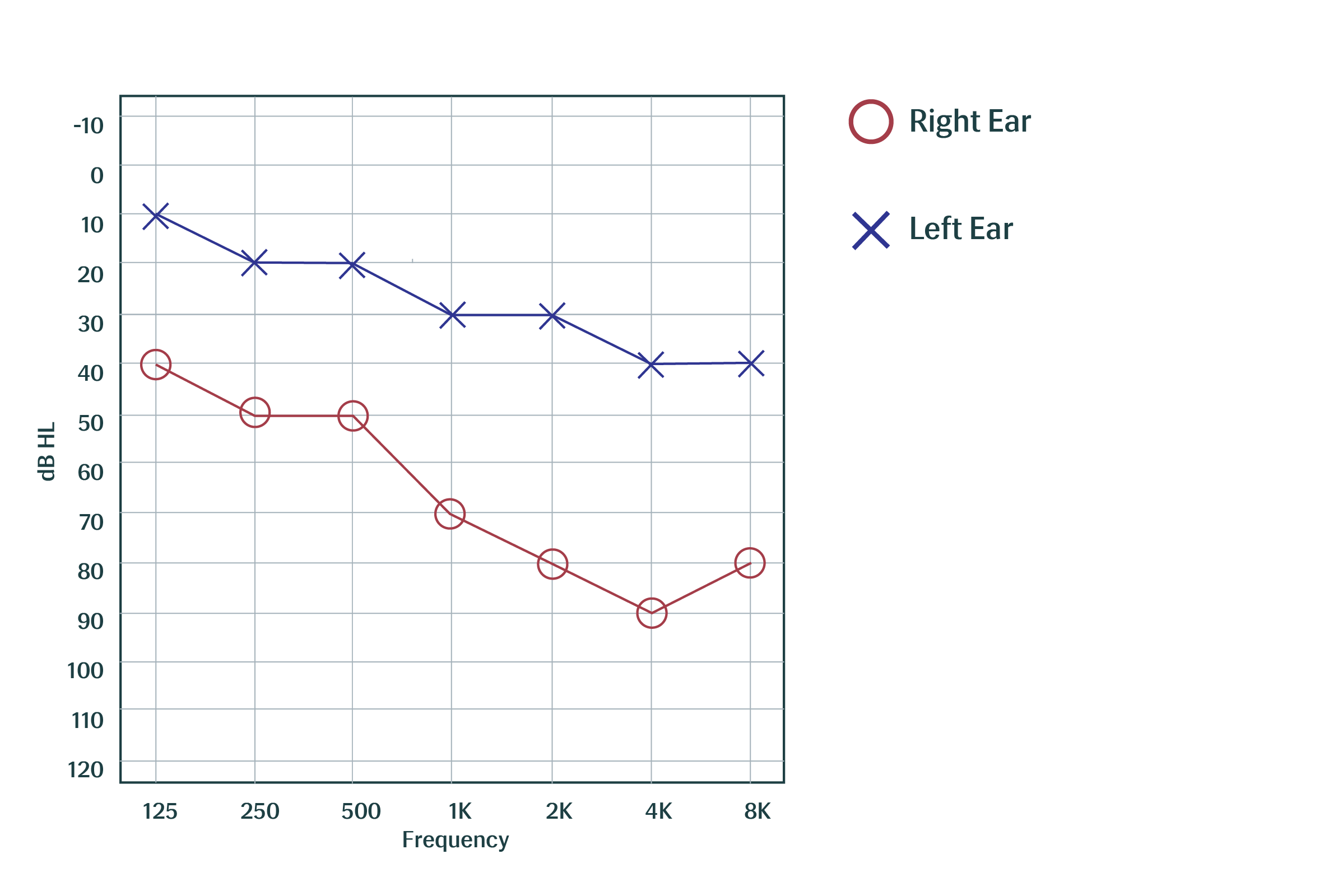 Understand Asymmetrical Hearing Loss & Available Solutions
