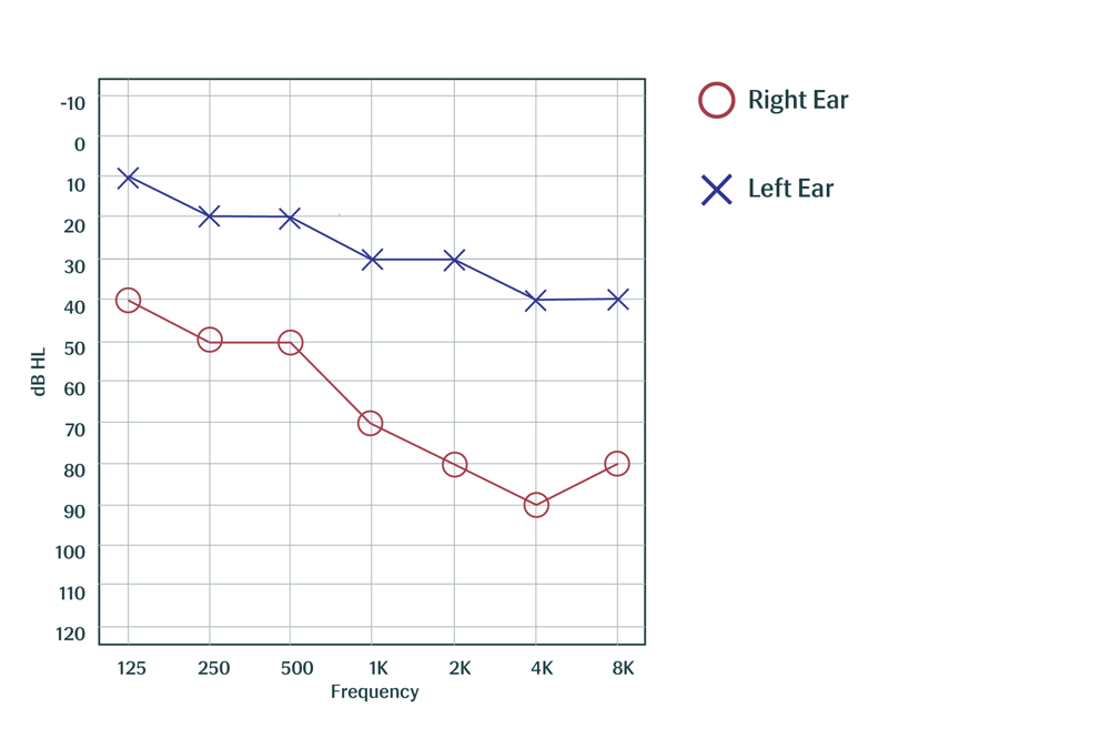 asymmetric hearing loss
